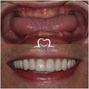 Full Mouth Dental Implants Turkey Package Deals - istanbul