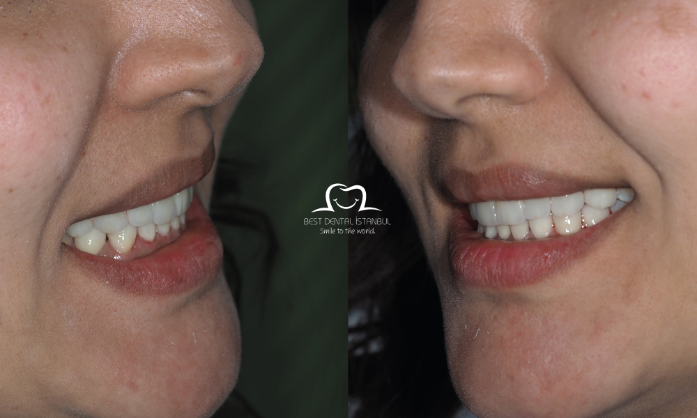 Full Set of Veneers Turkey