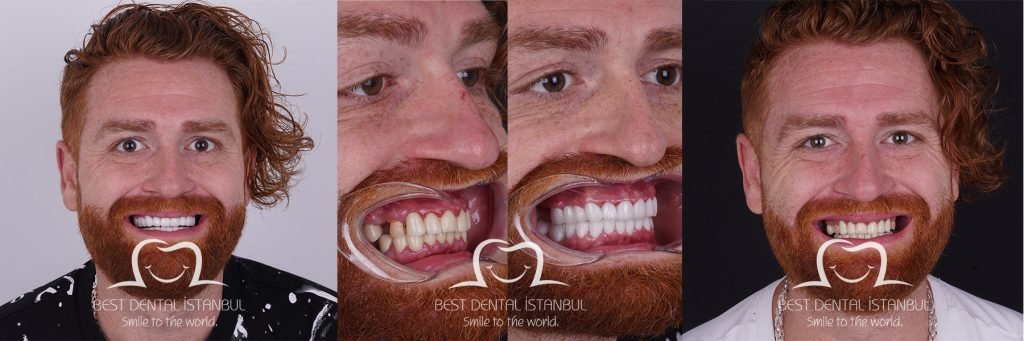 best veneers in turkey