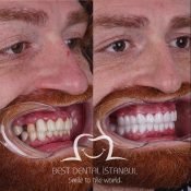 best veneers in turkey