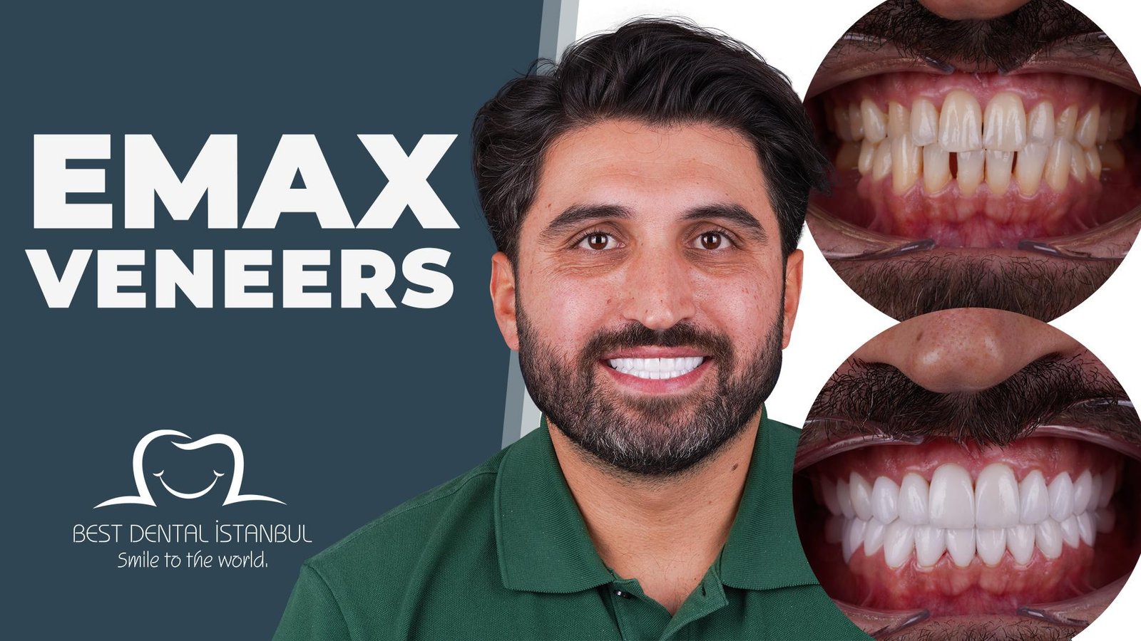 Full Set of Emax Veneers