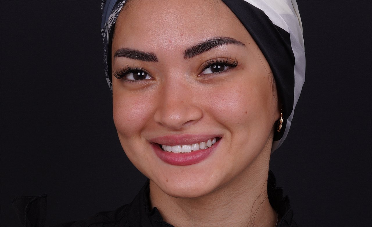 After-Photos-of-Teeth-Whitening