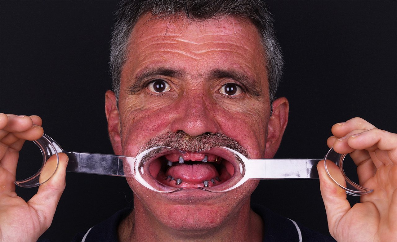 All-on-6 Dental Implants in Turkey After Photos