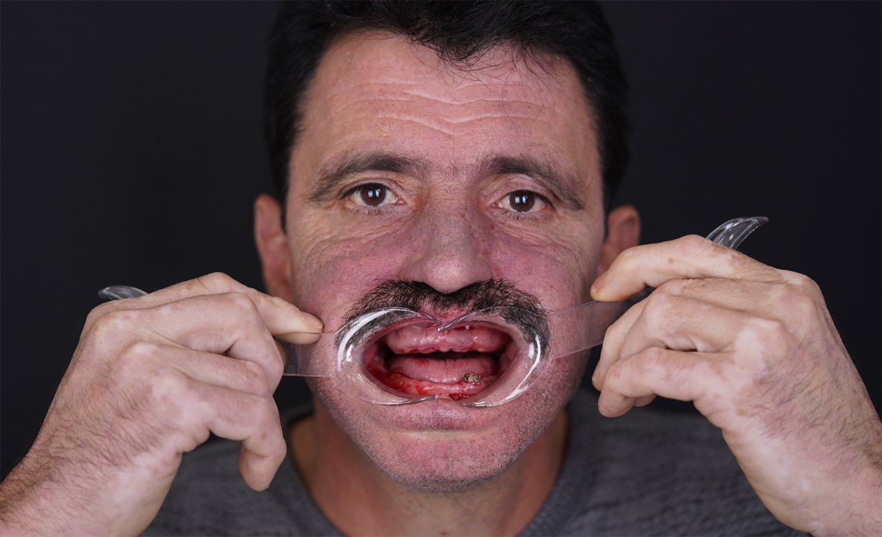 All-on-6 Dental Implants in Turkey Before Photos