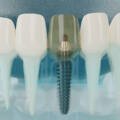 Best dental implant brands in the world : Top 6 implant brands.