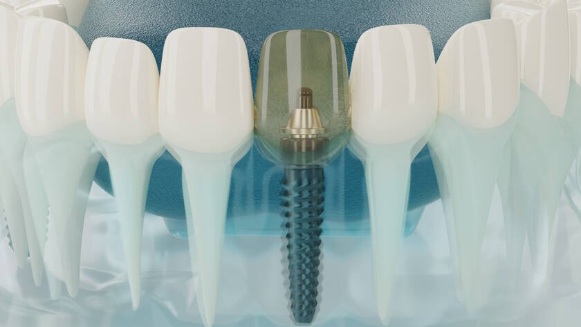 Best dental implant brands in the world : Top 6 implant brands.