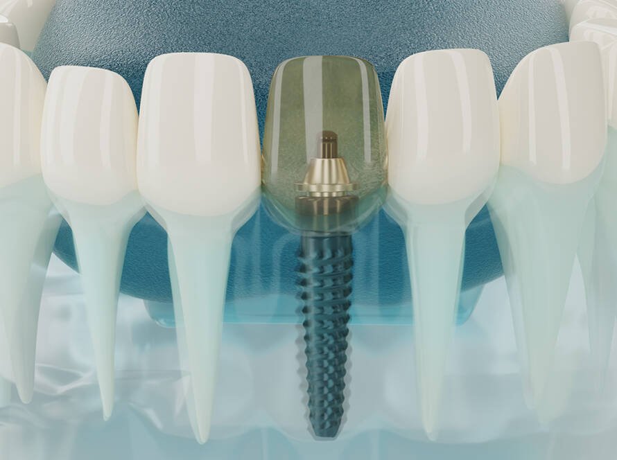 Best dental implant brands in the world : Top 6 implant brands.