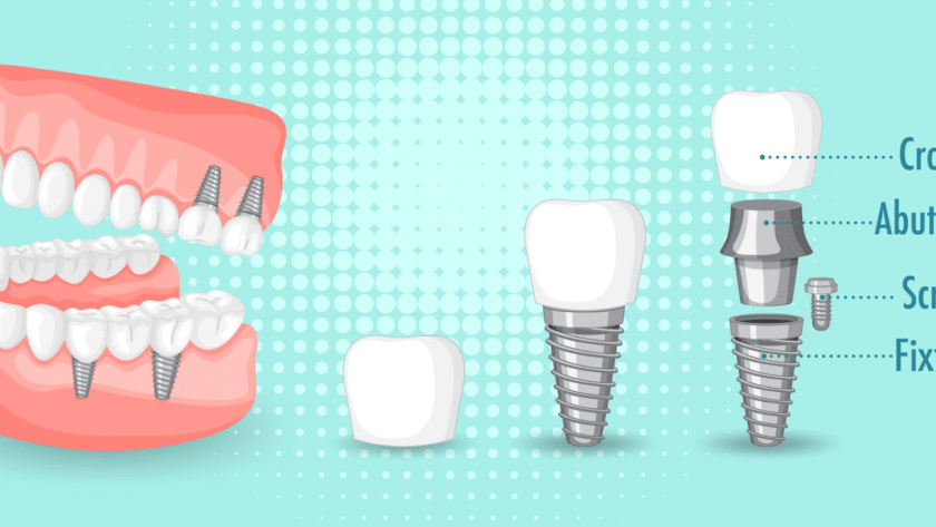 What are the 4 types of dental implants
