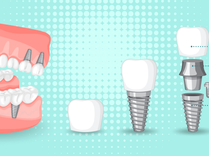 What are the 4 types of dental implants