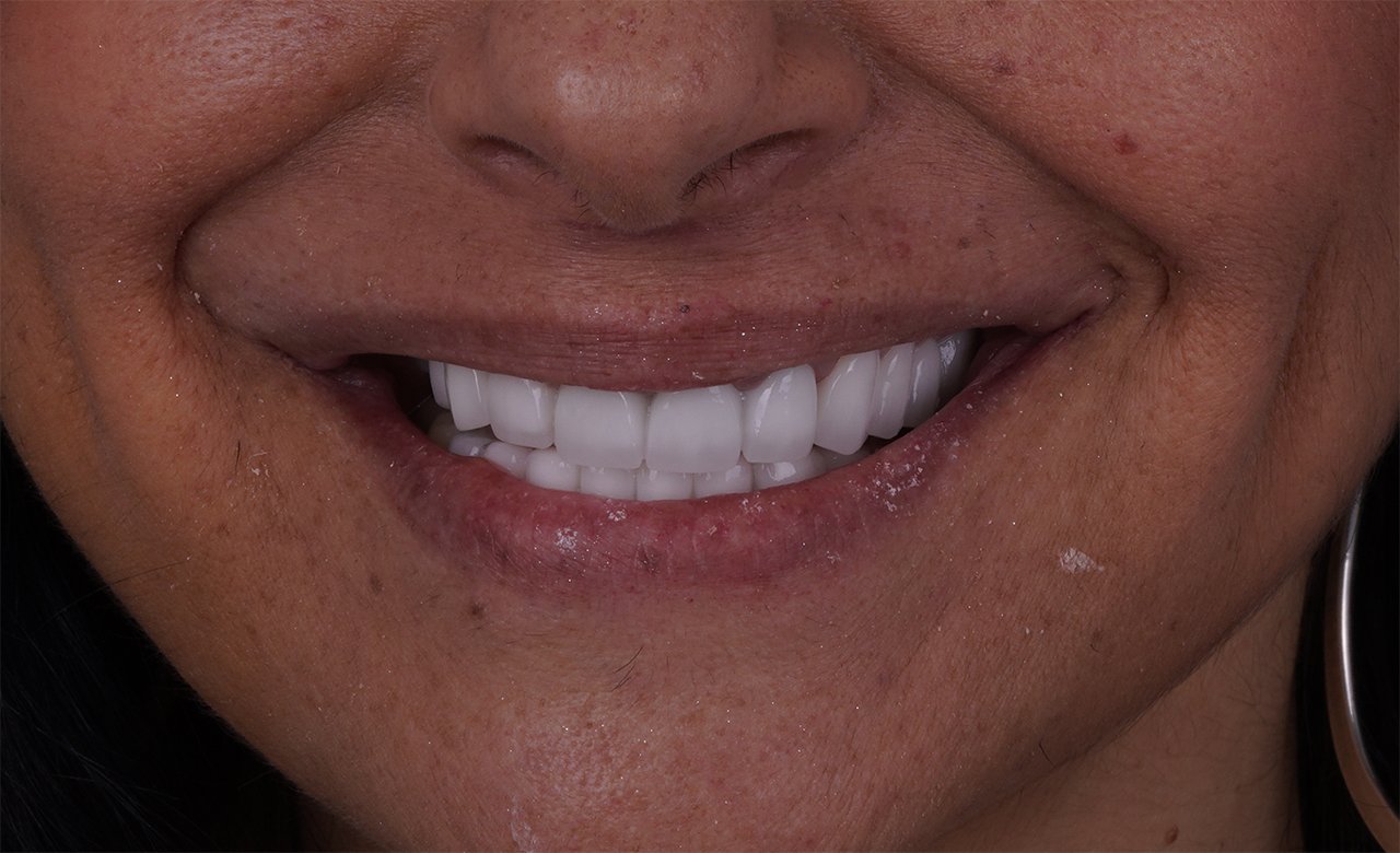 after dental crowns turkiye