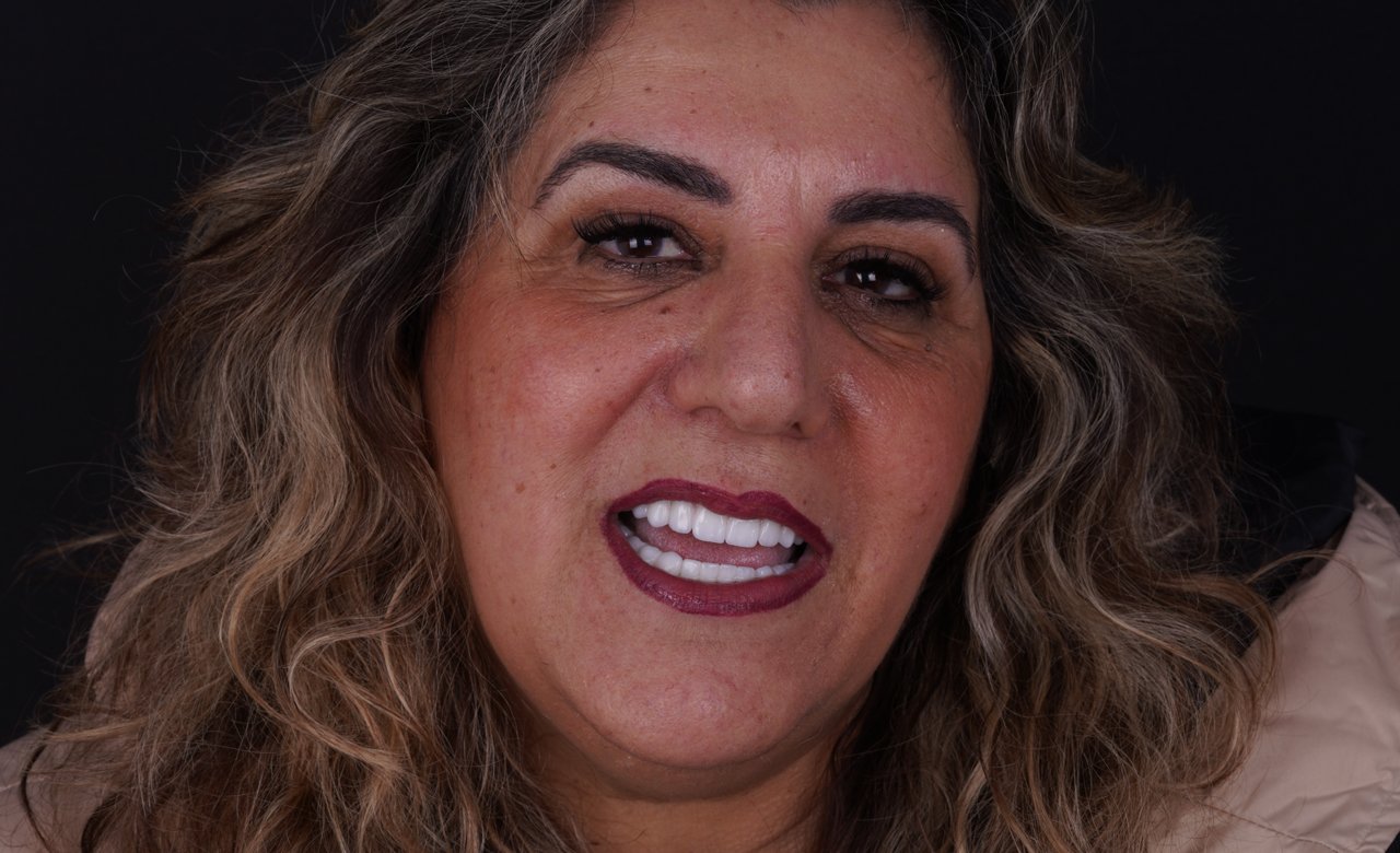 after images all-on-4 dental implants