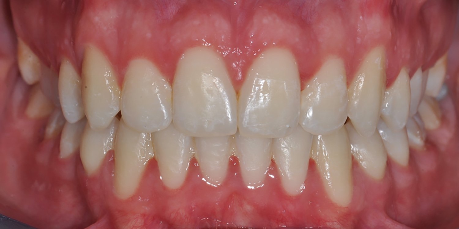 after orthodontic treatments
