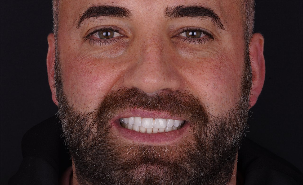 after images teeth cleaning in turkey