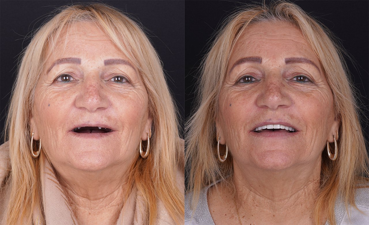 All on 4 Dental Implants in Turkey Before and After Photos