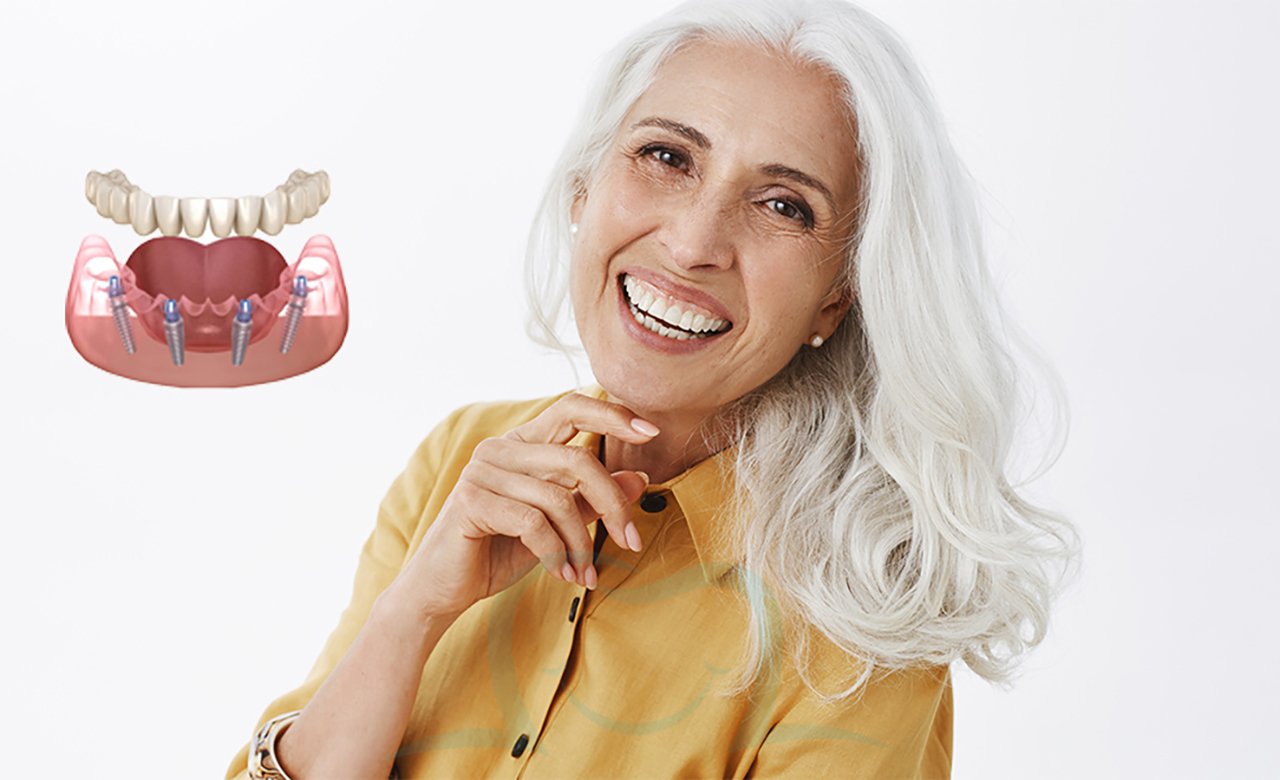 All on 4 Dental Implants in Turkey
