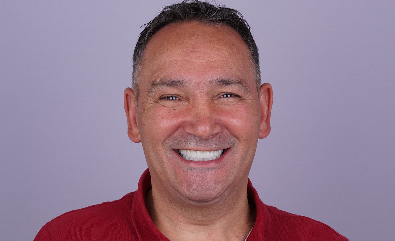 All-on-6 Dental Implants in Turkey After Photos