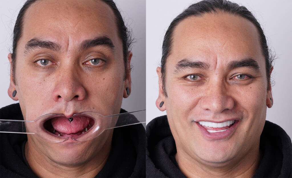 All-on-6 Dental Implants in Turkey Before and After Photos