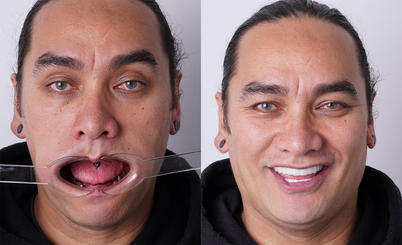 All-on-6 Dental Implants in Turkey Before and After Photos