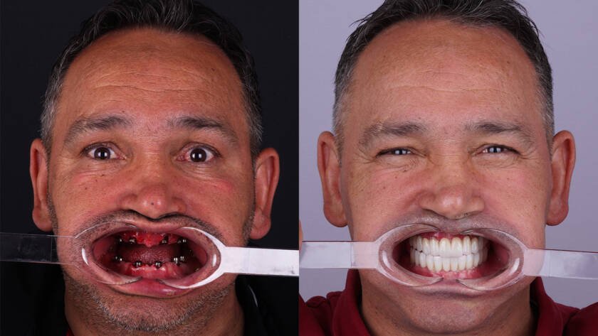 All-on-6 Dental Implants in Turkey Before and After Photos