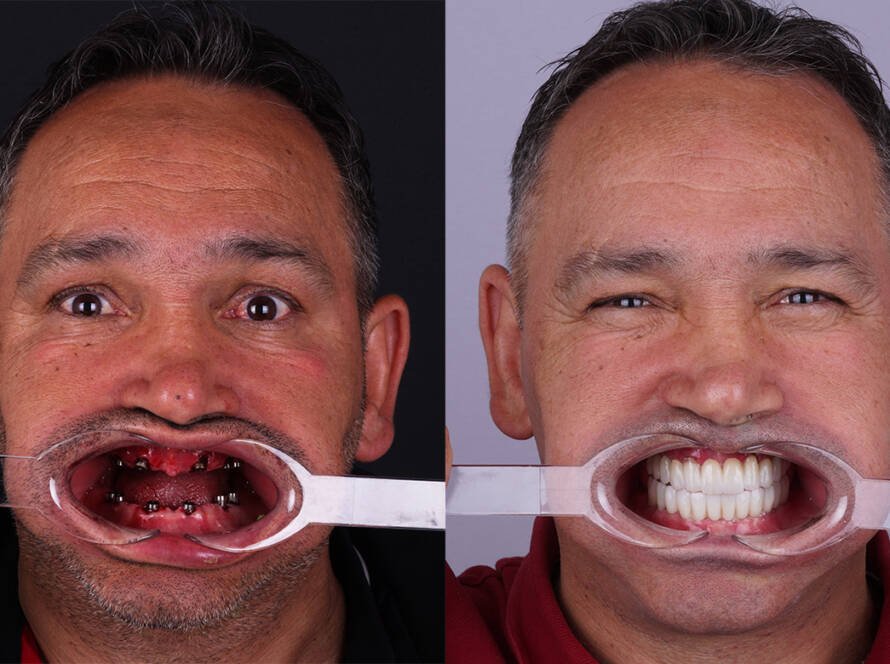 All-on-6 Dental Implants in Turkey Before and After Photos