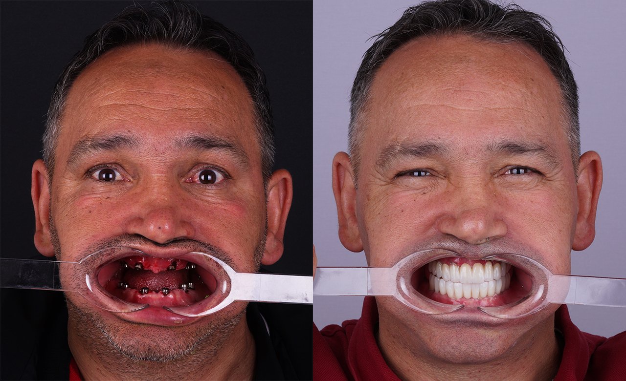All-on-6 Dental Implants in Turkey Before and After Photos
