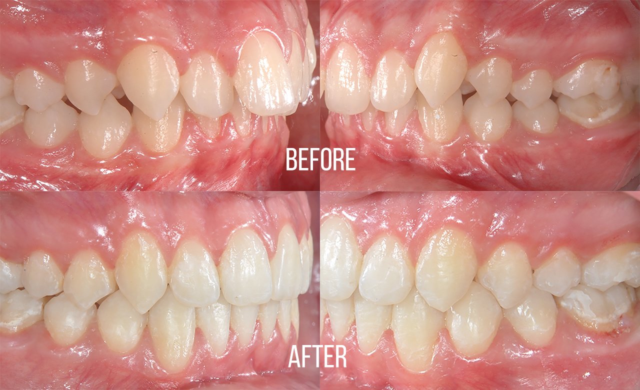 before and after orthodontic treatments