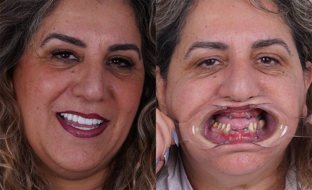 before and after photo all-on-4 dental implants