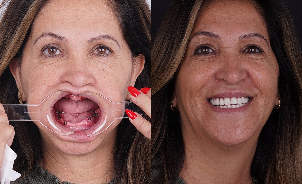 before and after dental implants in turkey
