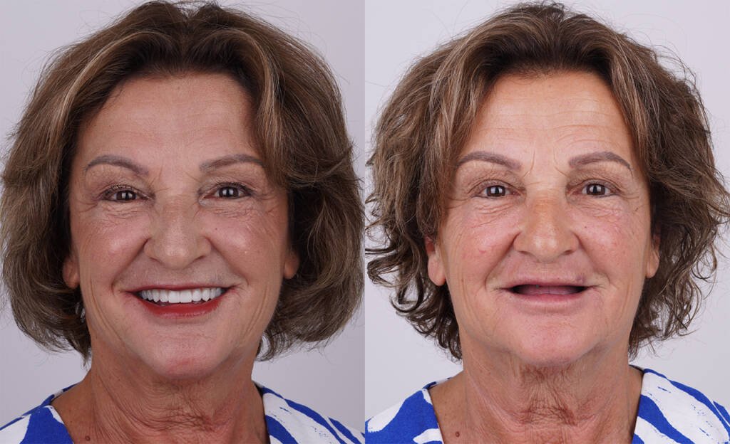 before and after dental implants turkey