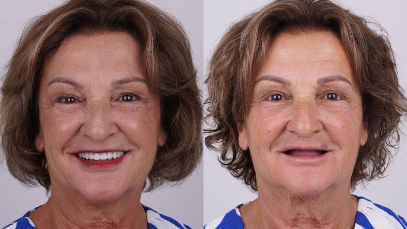 before and after dental implants turkey