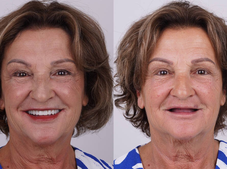before and after dental implants turkey