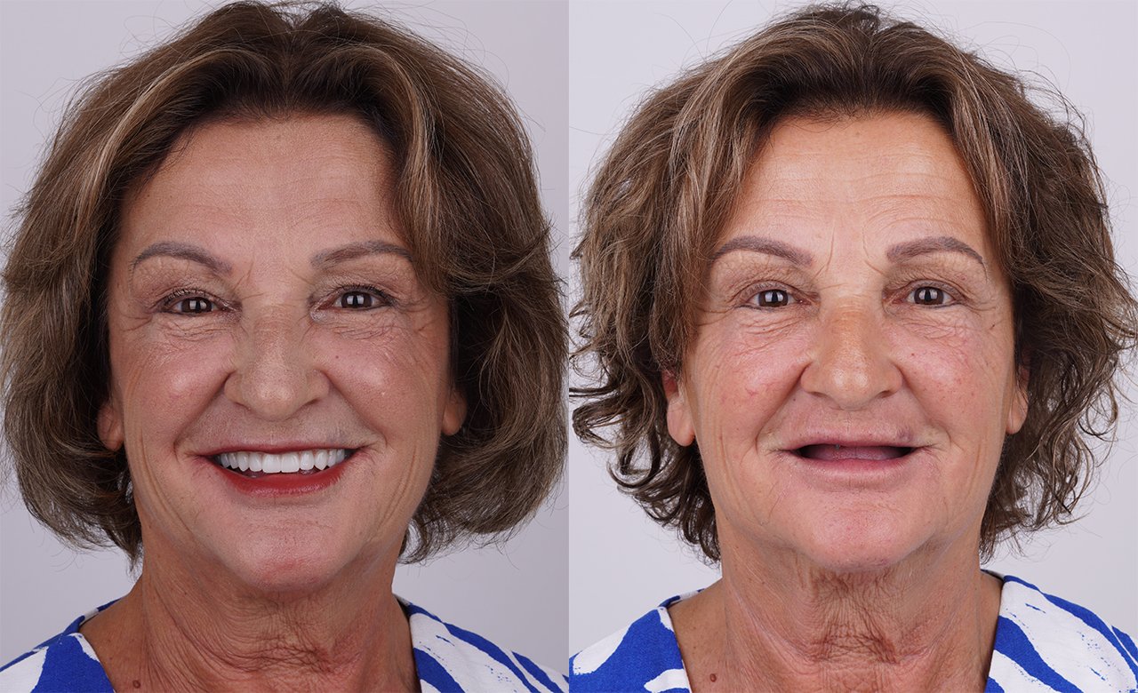 before and after dental implants turkey