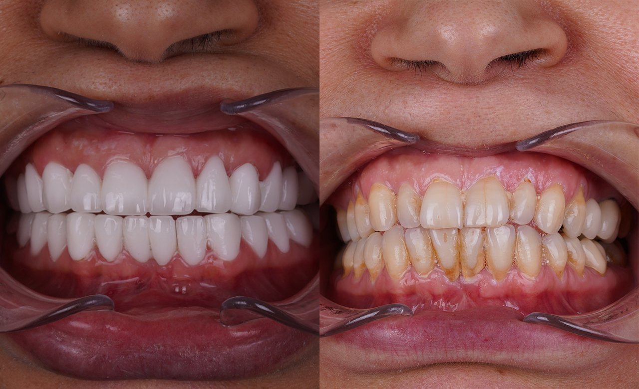 before and after dental crowns in turkey