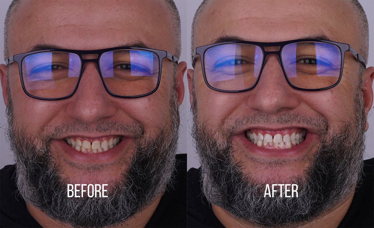 before and after images teeth cleaning in turkey