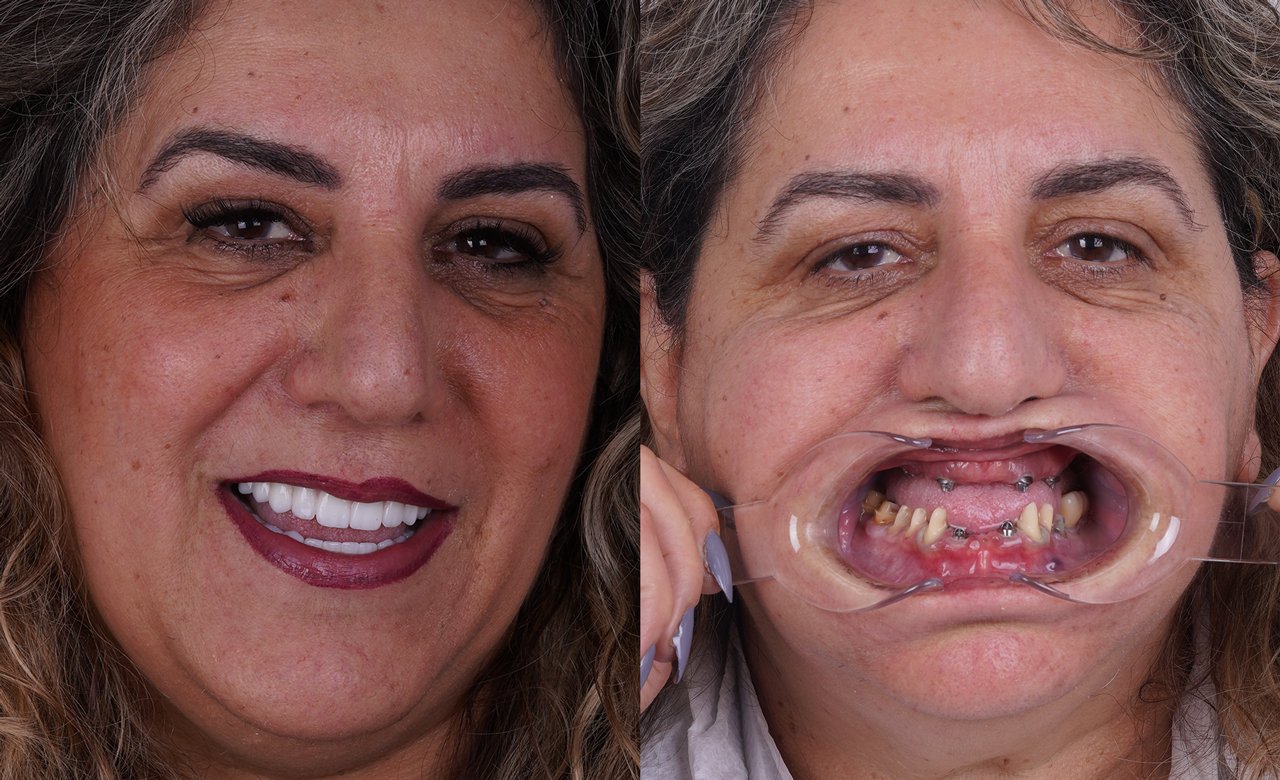 before and after photos dental implants in turkey
