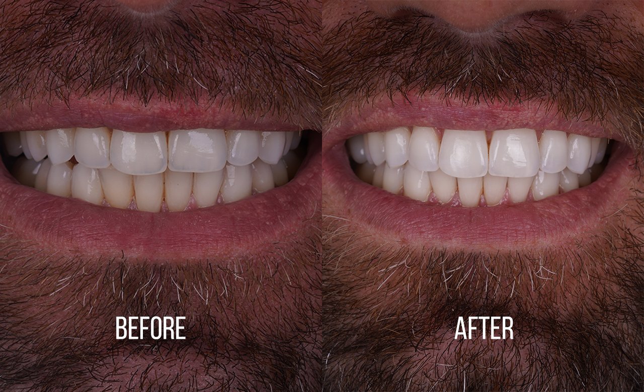 before and after images teeth cleaning in turkey