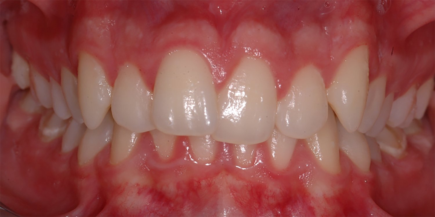 before orthodontic treatments