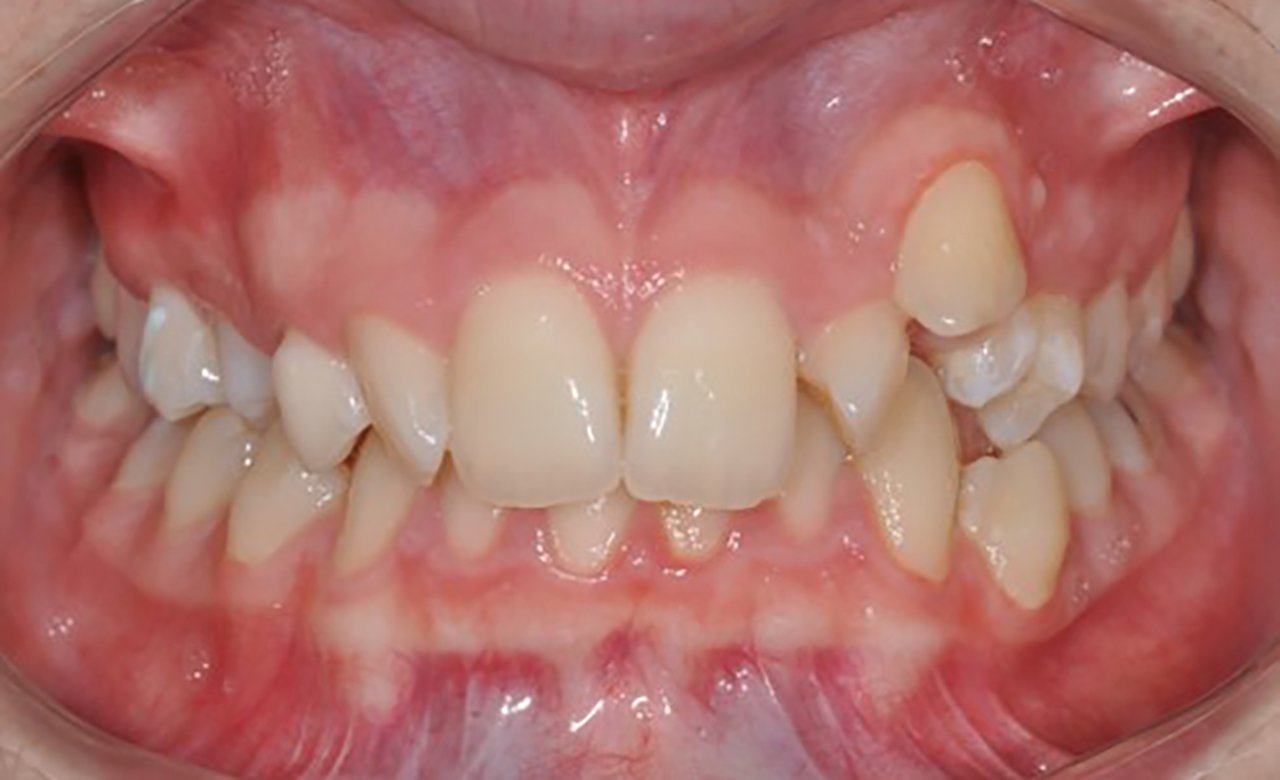 before-photo-orthodontic-treatments