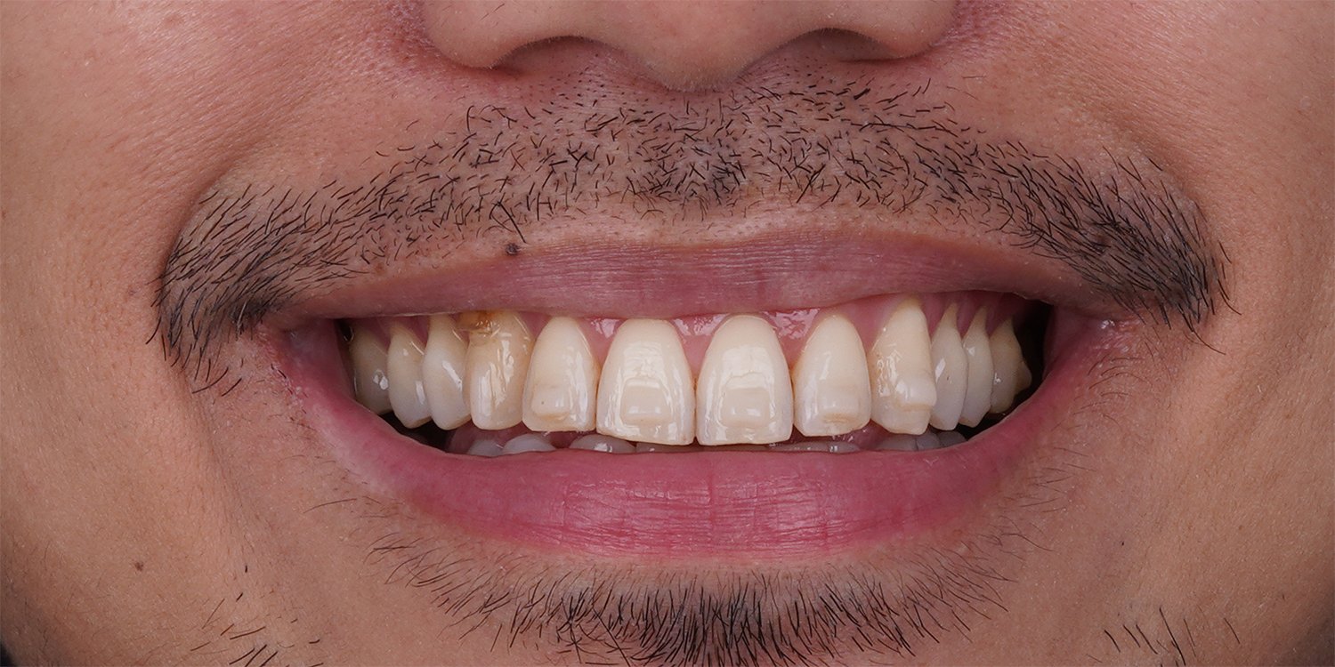 Before