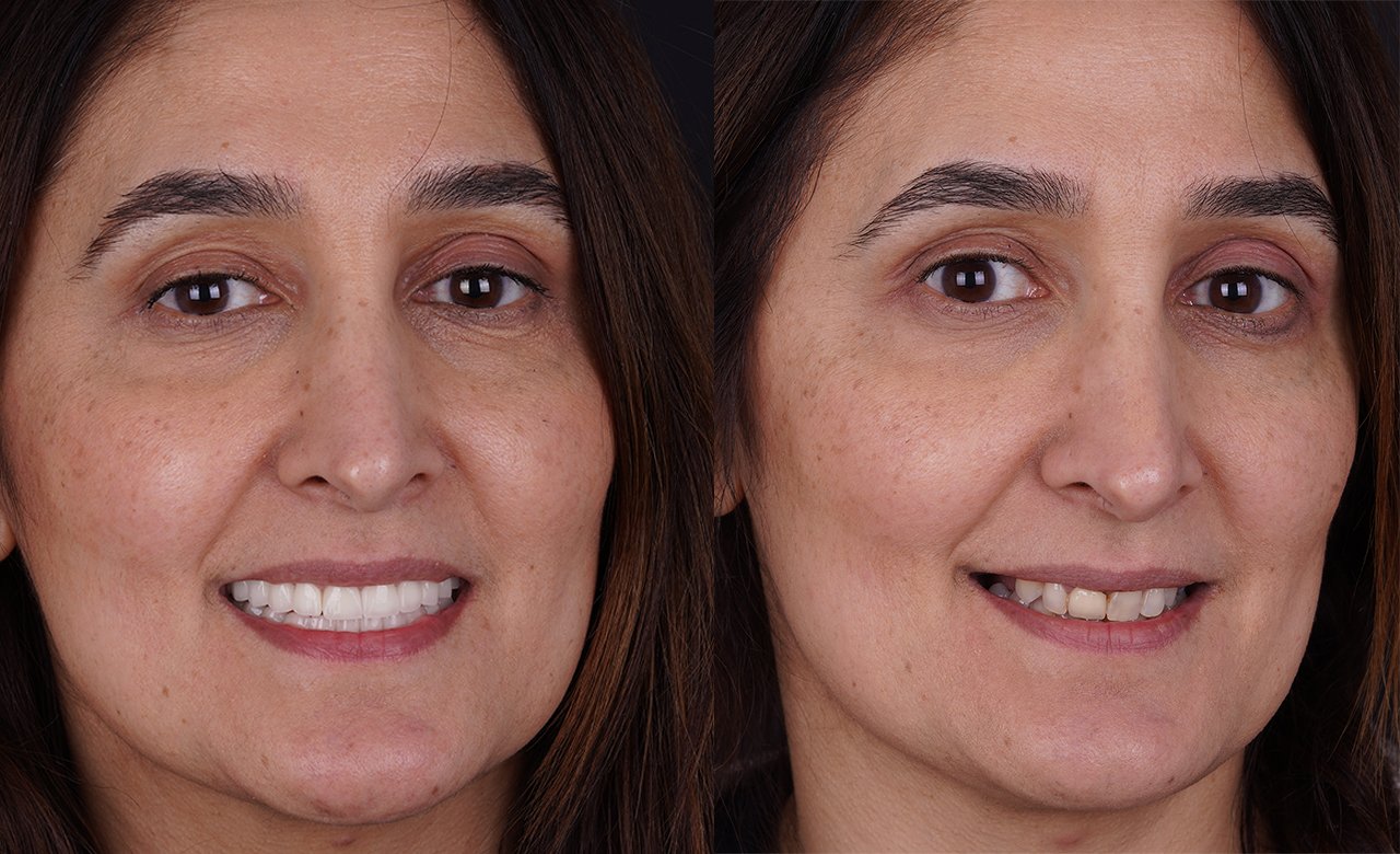 before and after dental crowns turkey