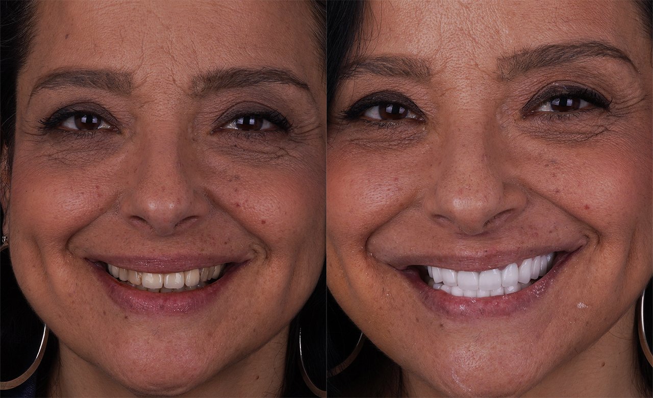 before and after dental crowns turkiye