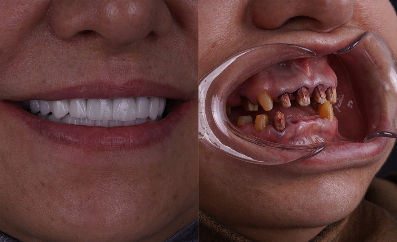 dental crowns revisions in turkey