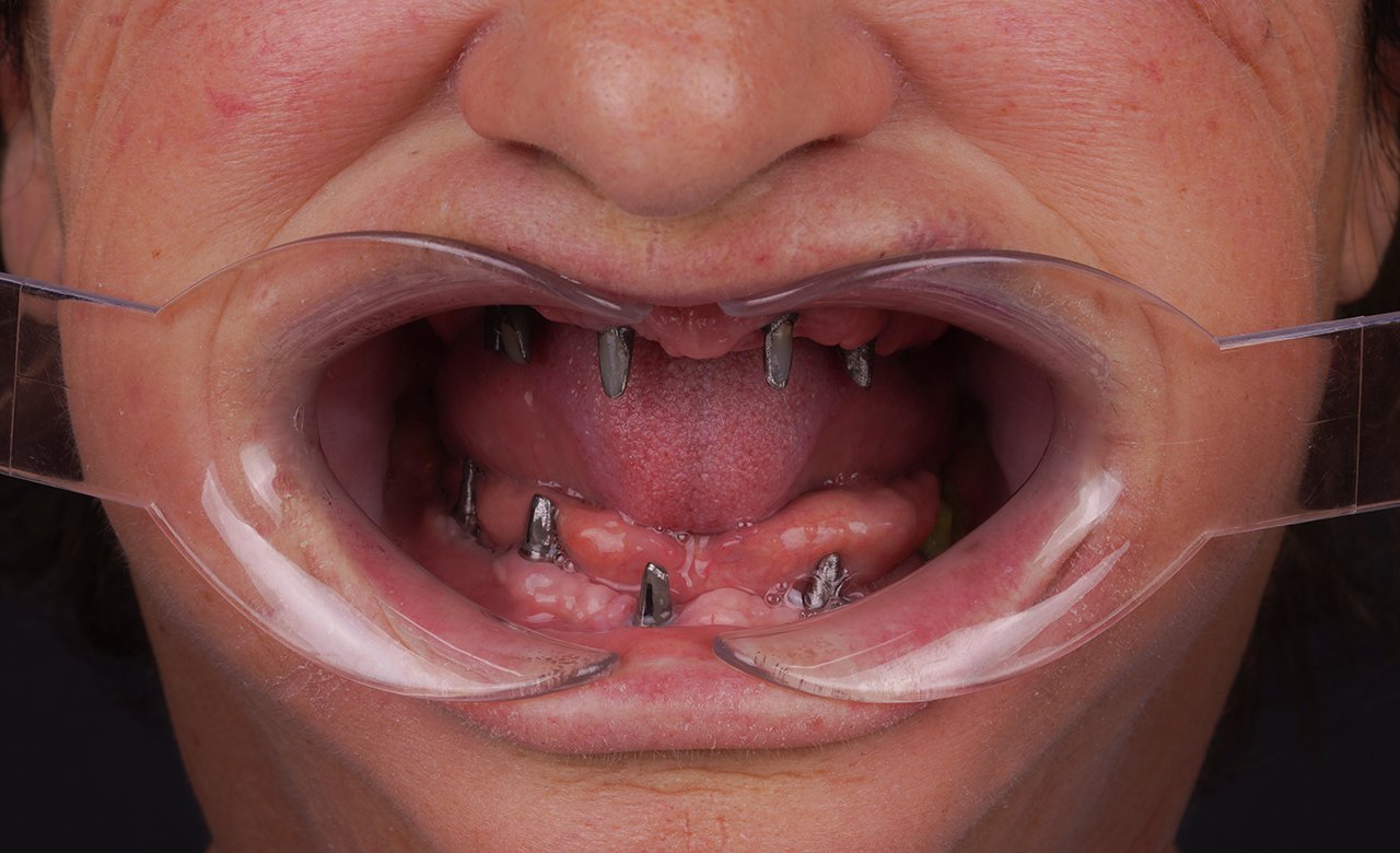 dental implant in turkey