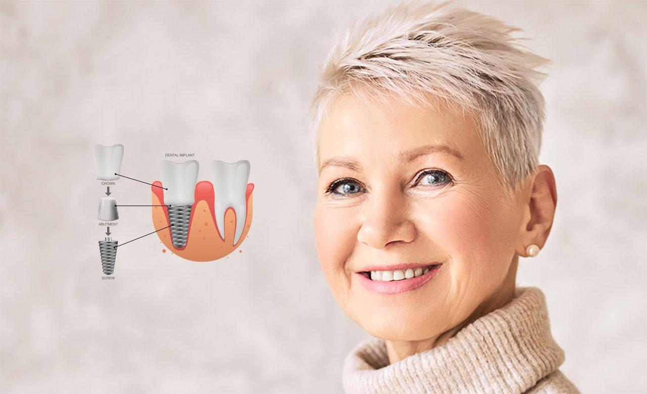 Dental Implants Turkey