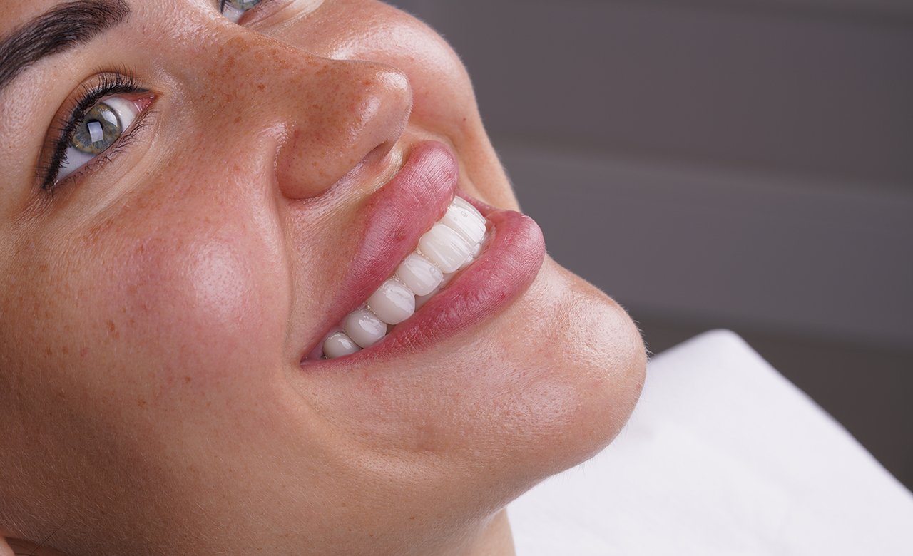 dental laminate veneers in turkey