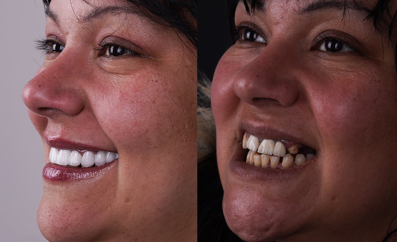 dental zirconium crowns turkey