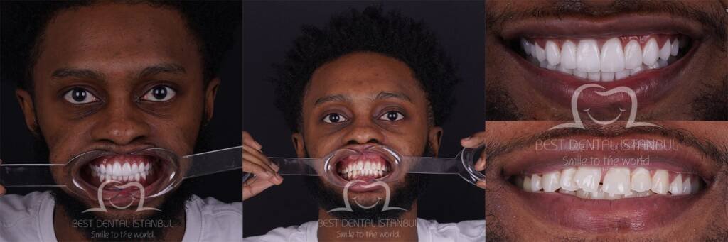 smile makeover in turkey - full set of veneers