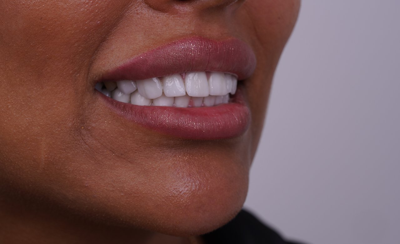 Full Set of Veneers in Turkey