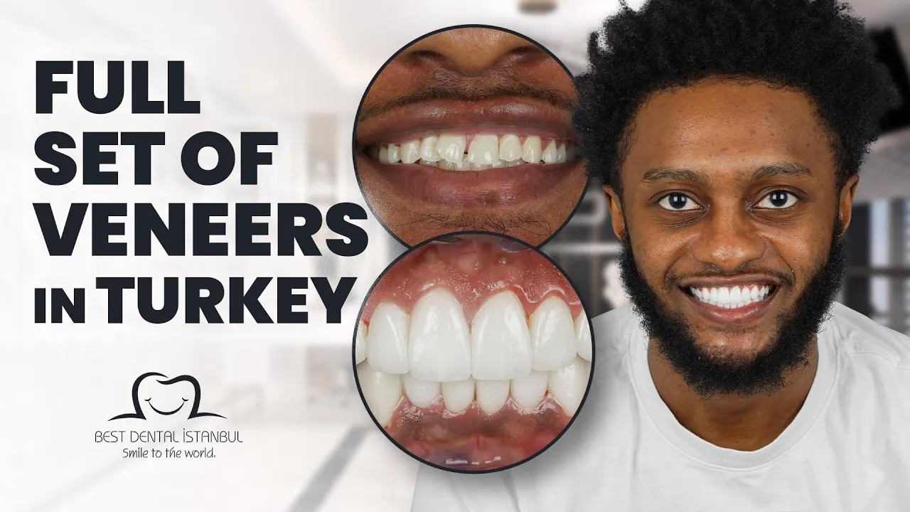 full set of veneers in turkey