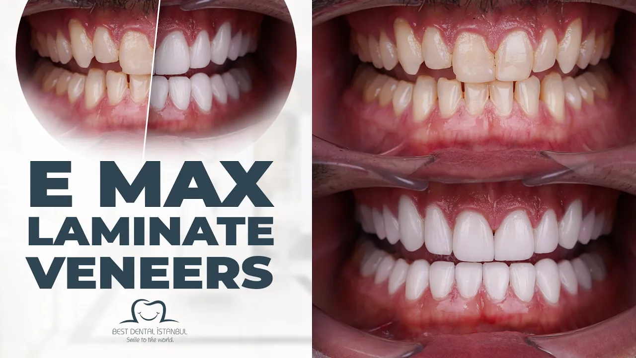 full set of veneers turkey